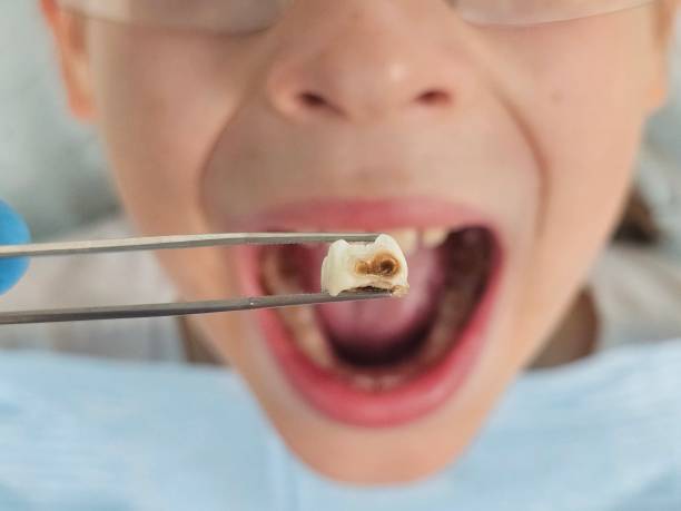 Best Knocked-Out Tooth (Avulsed Tooth) Treatment in Wayne, IL