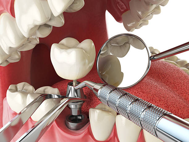 Best Broken or Chipped Tooth Repair in Wayne, IL